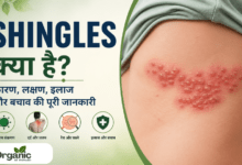 Shingles
