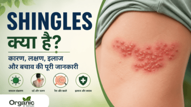 Shingles