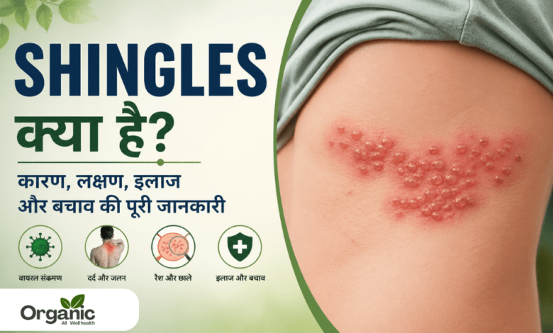 Shingles