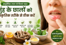 Ayurvedic remedies to heal mouth ulcers naturally with mulethi, honey, ghee, and cooling foods