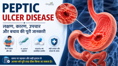 Peptic Ulcer Disease infographic showing stomach ulcer, H. pylori infection, NSAID use, symptoms, causes, treatment, and prevention of peptic ulcers.