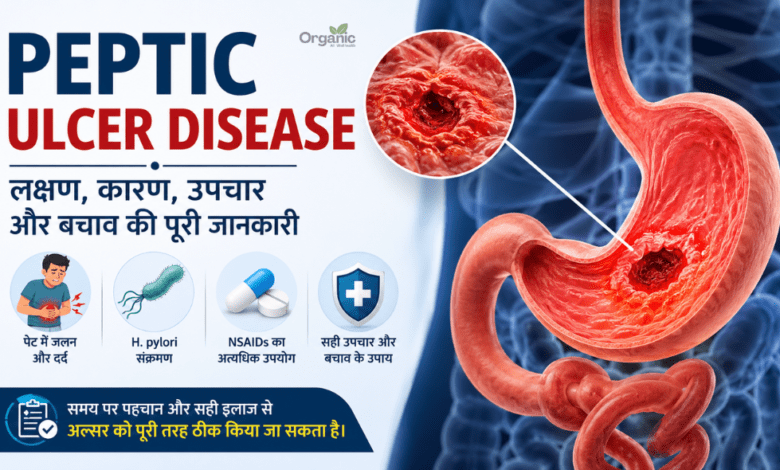 Peptic Ulcer Disease infographic showing stomach ulcer, H. pylori infection, NSAID use, symptoms, causes, treatment, and prevention of peptic ulcers.