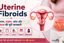 Uterine Fibroids in women – causes, symptoms, diagnosis, and treatment illustration.