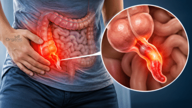 Appendicitis में सूजे हुए अपेंडिक्स का मेडिकल चित्र, जो पेट के निचले दाहिने हिस्से में इसकी स्थिति दिखाता है।
