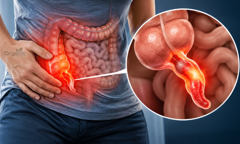 Appendicitis में सूजे हुए अपेंडिक्स का मेडिकल चित्र, जो पेट के निचले दाहिने हिस्से में इसकी स्थिति दिखाता है।
