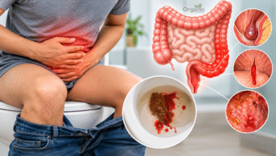 Blood in Stool यानी मल में खून आने के संभावित कारण और मानव पाचन तंत्र का मेडिकल चित्र।