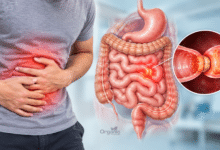 Bowel Obstruction यानी आंत्र बाधा का मेडिकल चित्र जिसमें छोटी और बड़ी आंत में रुकावट दिखाई गई है।