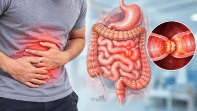 Bowel Obstruction यानी आंत्र बाधा का मेडिकल चित्र जिसमें छोटी और बड़ी आंत में रुकावट दिखाई गई है।