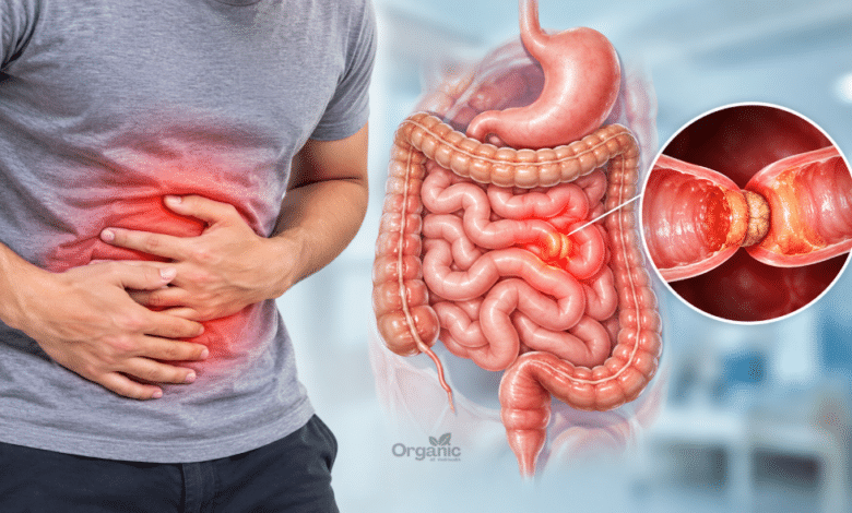 Bowel Obstruction यानी आंत्र बाधा का मेडिकल चित्र जिसमें छोटी और बड़ी आंत में रुकावट दिखाई गई है।