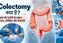 Colectomy सर्जरी में बड़ी आंत का प्रभावित हिस्सा निकालने की चिकित्सकीय प्रक्रिया का चित्र