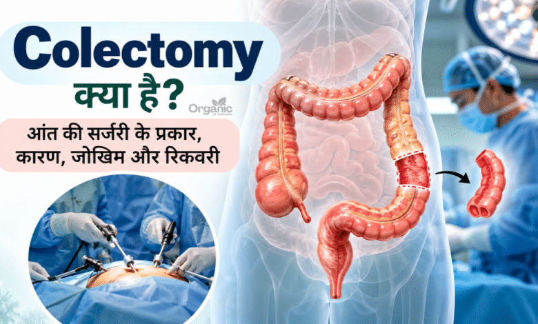 Colectomy सर्जरी में बड़ी आंत का प्रभावित हिस्सा निकालने की चिकित्सकीय प्रक्रिया का चित्र
