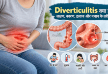 Diverticulitis को दर्शाता मेडिकल चित्र जिसमें बड़ी आंत की दीवार पर बनी छोटी थैलियों में सूजन दिखाई गई है।