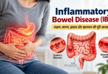 Inflammatory bowel disease (IBD) को समझाने वाला मानव पाचन तंत्र और बड़ी तथा छोटी आंत का मेडिकल चित्र।